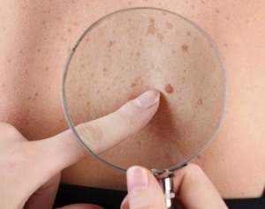 4 biểu hiện bất thường trên da có thể là dấu hiệu sớm của ung thư